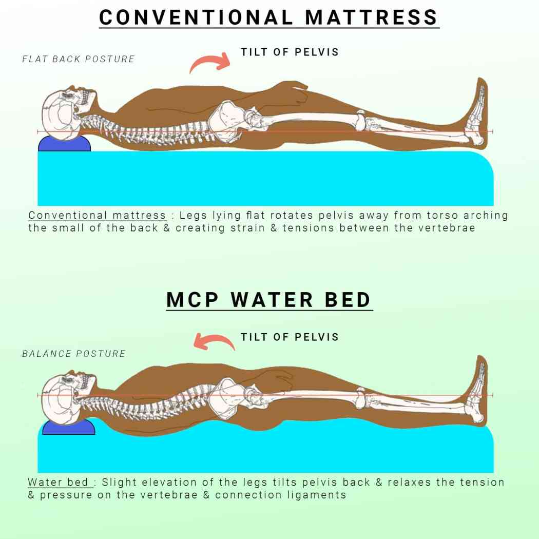 Water Mattress for Bed Sores in Hyderabad